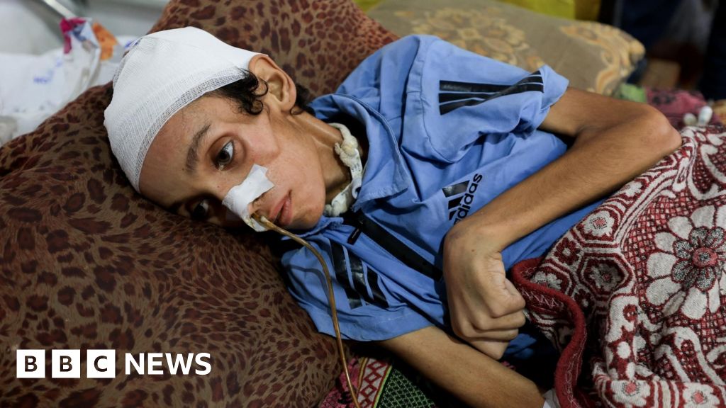 One in five children in Gaza is malnourished, UN aid agency says