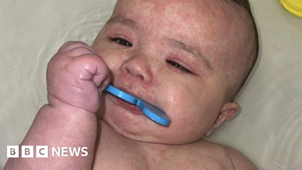 How Canada became the centre of a measles outbreak in North America