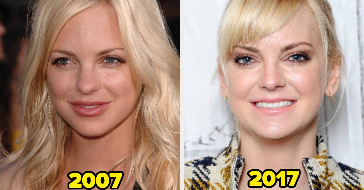 17 Celebs Who Dissolved Or Stop Getting Facial Fillers (And Why)